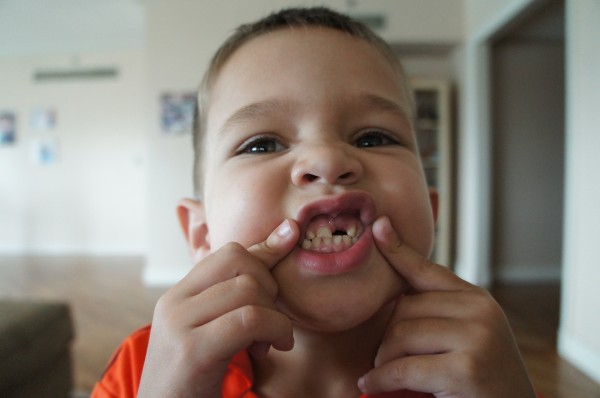 Mason's tooth got infected and had to be pulled
